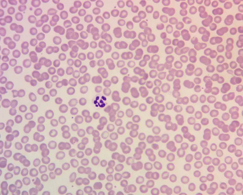 Image depicting a peripheral blood smear from a patient with megaloblastic anemia, highlighting the presence of hypersegmented neutrophils with six or more lobes