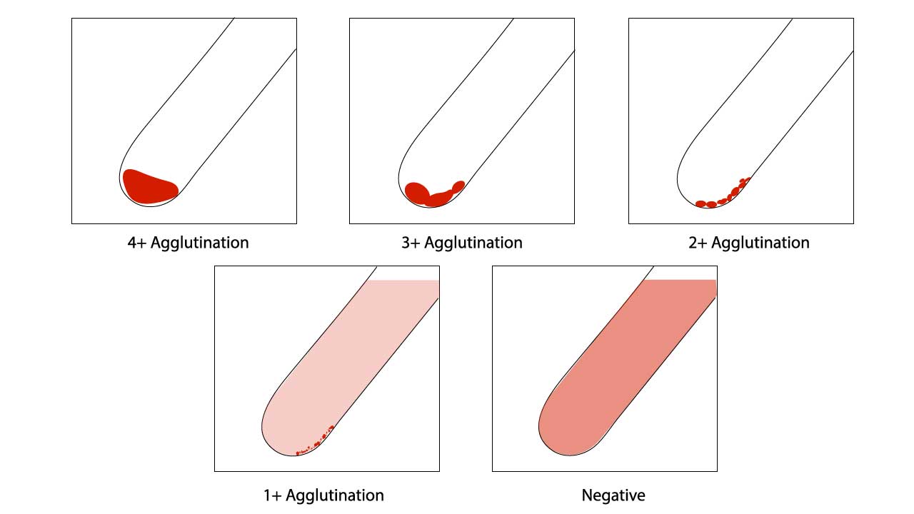 This image depicts the red cell agglutination test score for forward blood group typing, a crucial step in determining an individual's ABO and Rh D phenotype in ABO Rh test. The agglutination patterns observed in the test tubes provide clear and distinct indicators of the blood group, ensuring accurate blood compatibility assessments for transfusions.