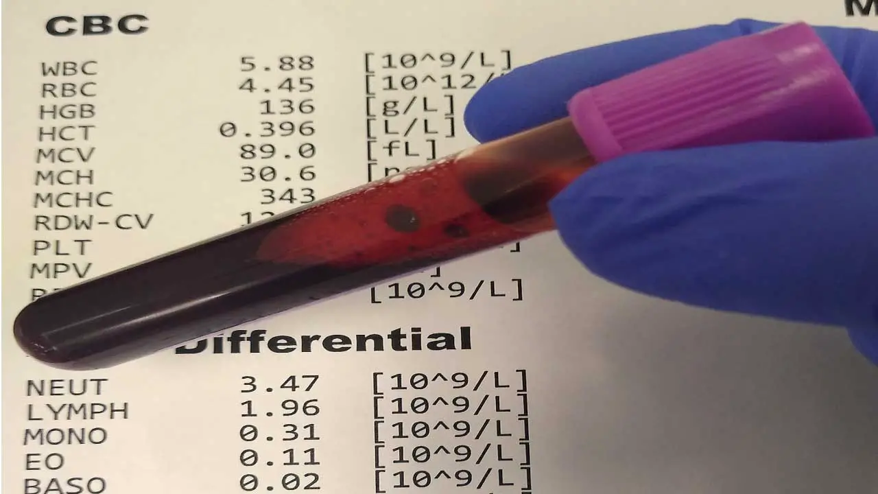 Blood sample for CBC with differential uses EDTA as anticoagulant.