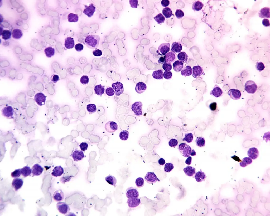 Peripheral blood smear showing numerous nucleated red blood cells and dysplastic myeloblasts in acute myeloid leukemia.