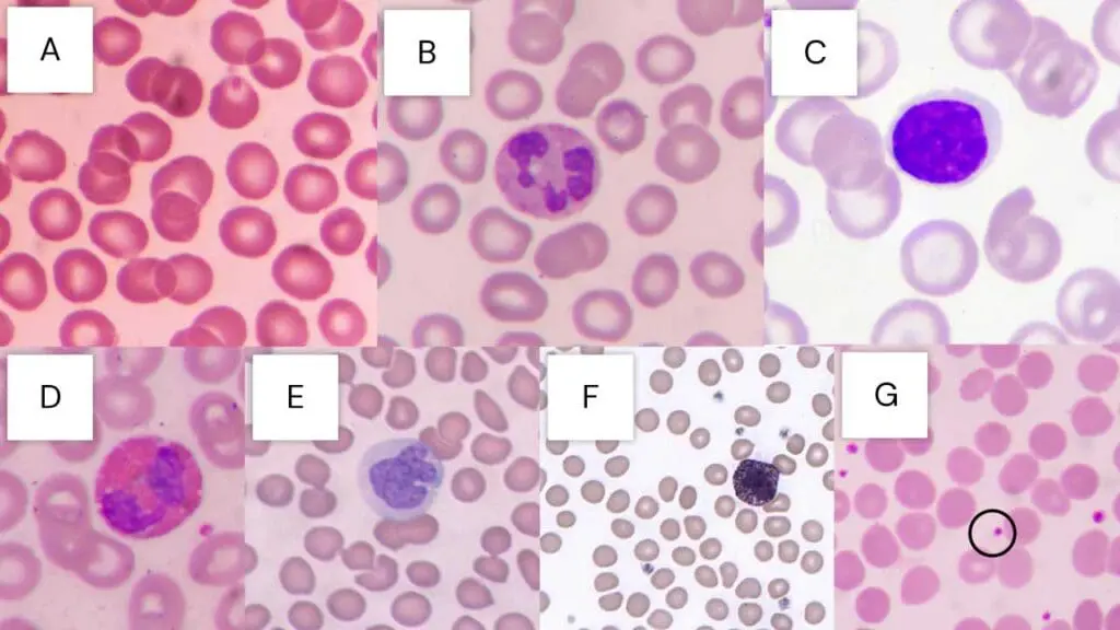 Different normal blood cells stained by Leishman stain that can be seen under the microscope. Panel A shows presence of red blood cells. Panel B is a neutrophil. Panel C is a small lymphocytes. Panel D is an eosinophil. Panel E is a monocyte. Panel F is a basophil. Panel G shows presence of a platelet in the peripheral blood smear (black circle).