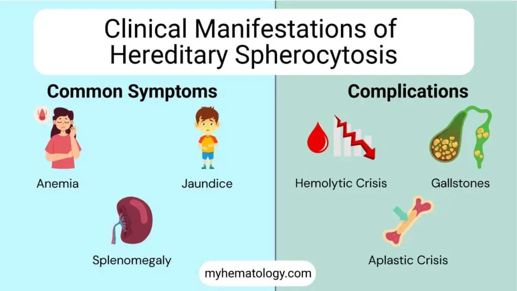 Clinical manifestations of hereditary spherocytosis including the triad symptoms of anemia, jaundice and splenomegaly. Complications include hemolytic crisis, gallstones and aplastic crisis.