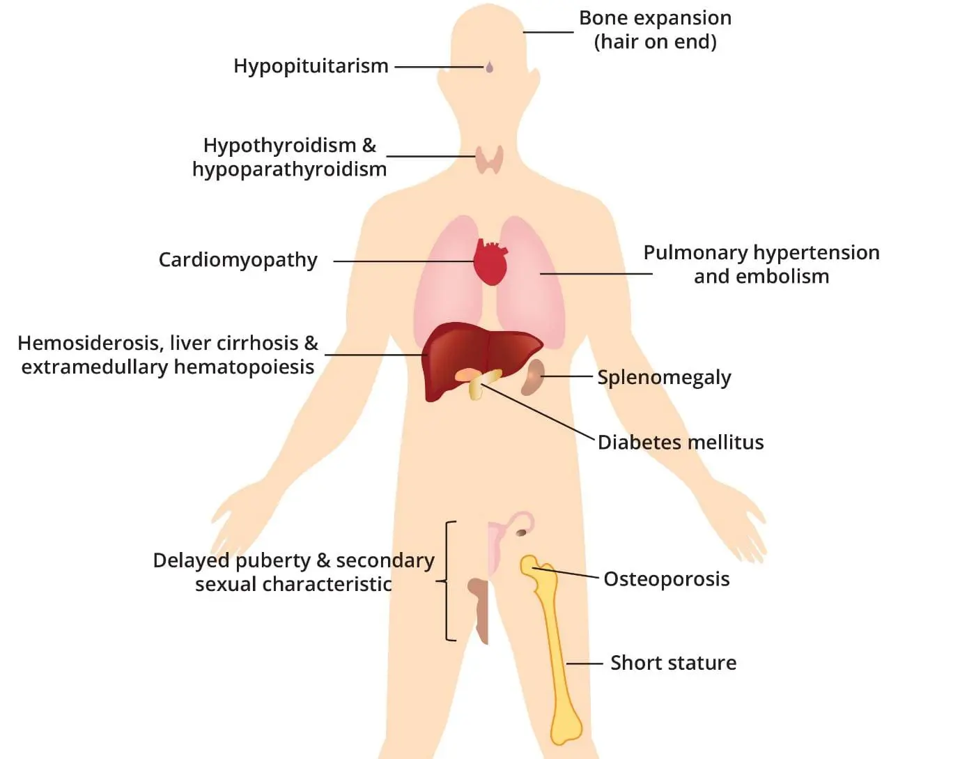 Image depicting the organ damage caused by beta thalassemia major, highlighting the impact of iron overload on various organs