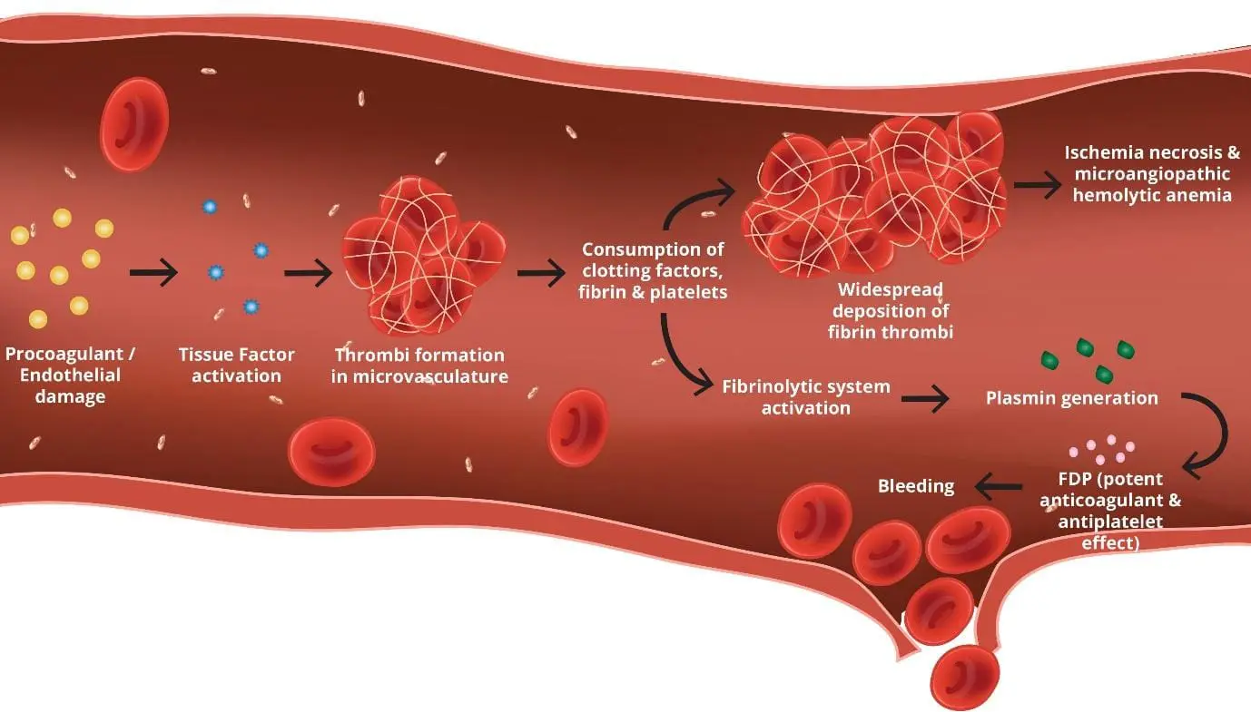 Unveiling the Devastating Cascade of disseminated intravascular coagulation (DIC): A Microscopic Journey through Hemolysis, Thrombosis, and Platelet Consumption in DIC