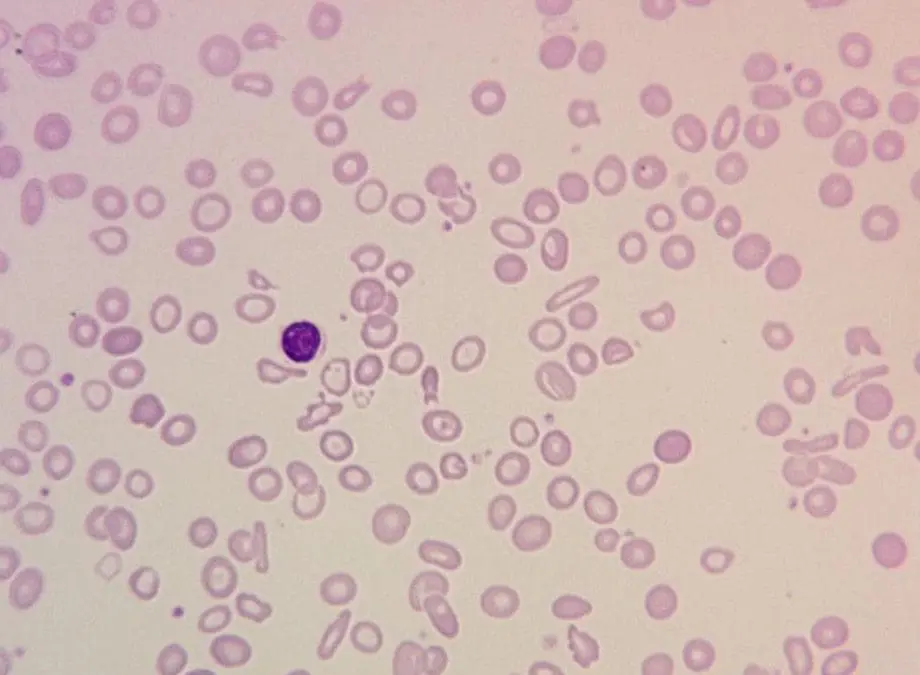 Iron Deficiency Anemia (IDA)