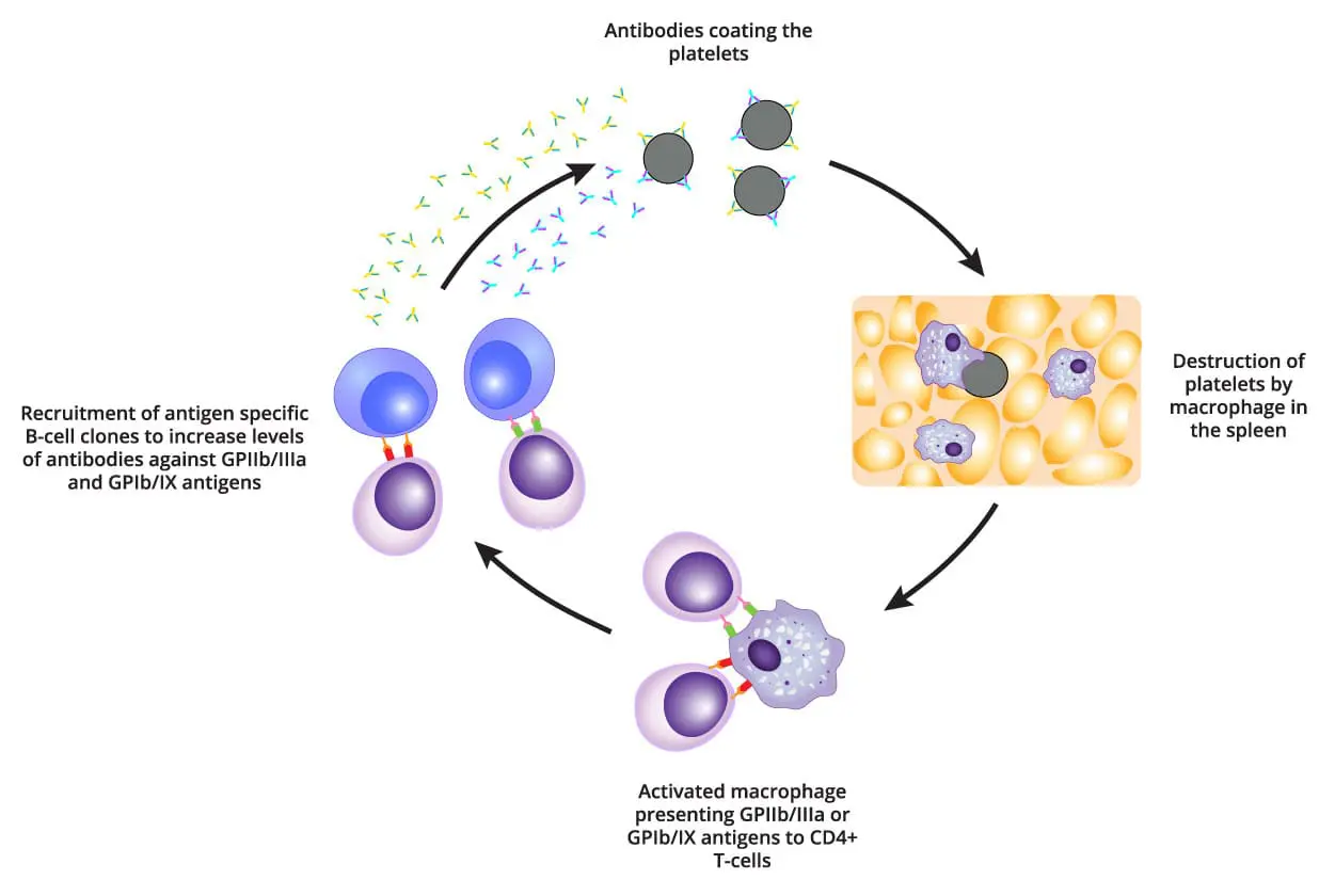 A Microscopic View of Platelet Destruction. Image depicting macrophages engulfing platelets coated in antibodies, illustrating the autoimmune-mediated destruction of platelets in primary immune thrombocytopenia (ITP)
