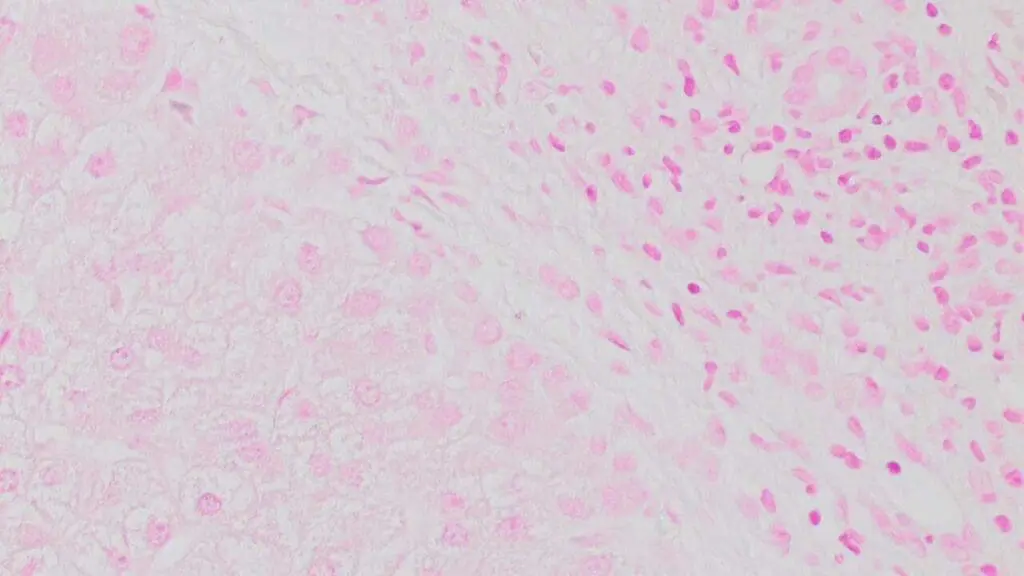 Liver biopsy of chronic alcoholic cirrhosis stained using Prussian Blue Stain showed no evidence of iron overload.