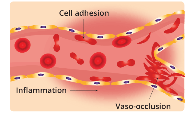 Sickle Cell Disease