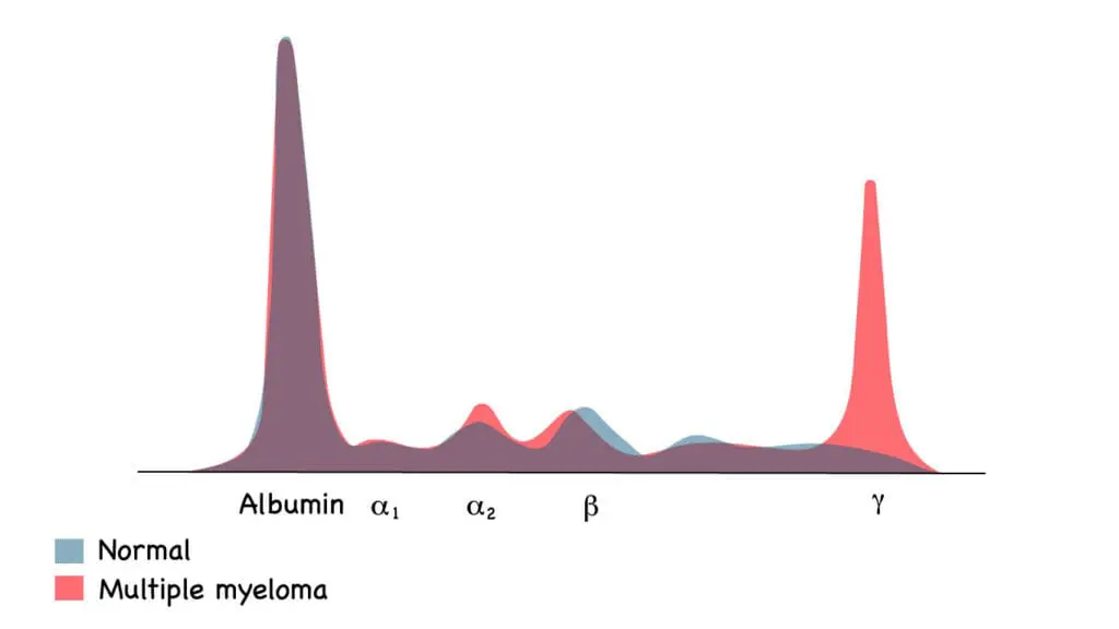 Serum protein electrophoresis showing the abnormal M protein spike in the gamma region in multiple myeloma