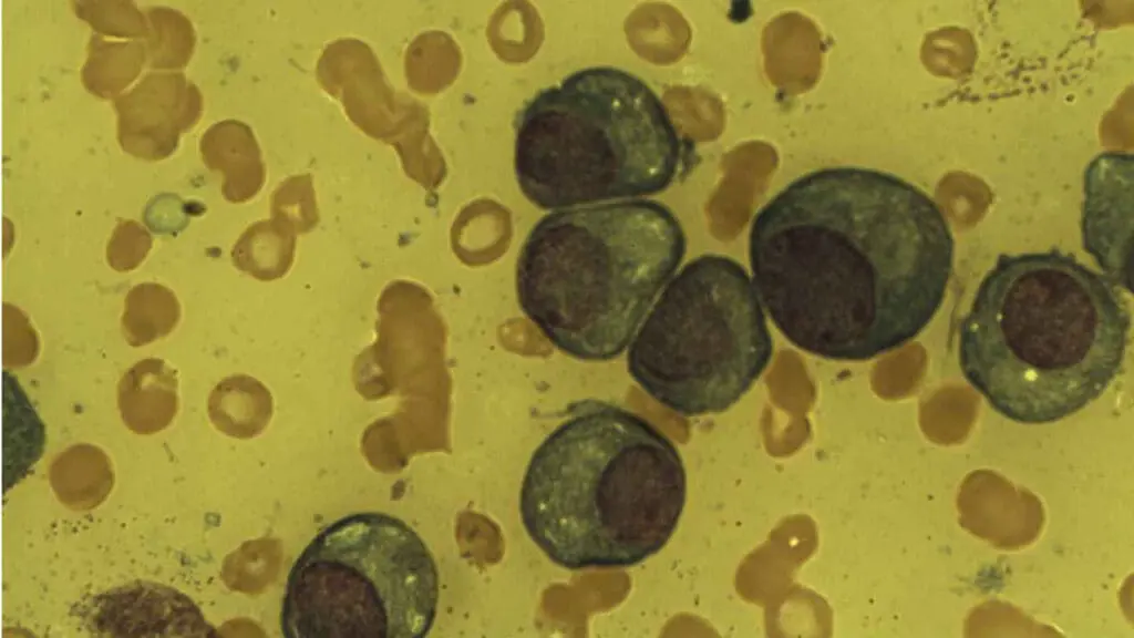 Presence of plasma cells in the bone marrow smear.