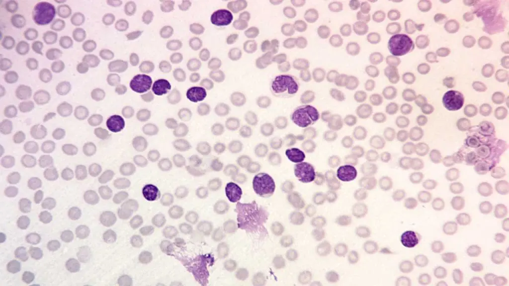 Acute lymphoblastic leukemia or ALL peripheral blood smear with lymphoblasts and some smudge cells and also normochromic normocytic anemia and thrombocytopenia at x 400 magnification.