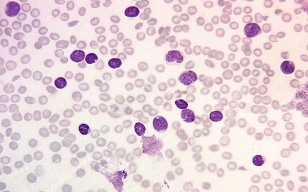 B-Cell Acute Lymphoblastic Leukemia (B-cell ALL)