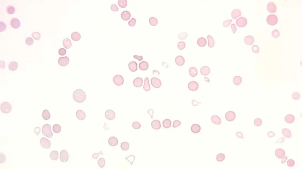 Peripheral blood smear at 400x magnification showcasing markedly reduced numbers of mature red blood cells, white blood cells, and platelets, reflecting pancytopenia.