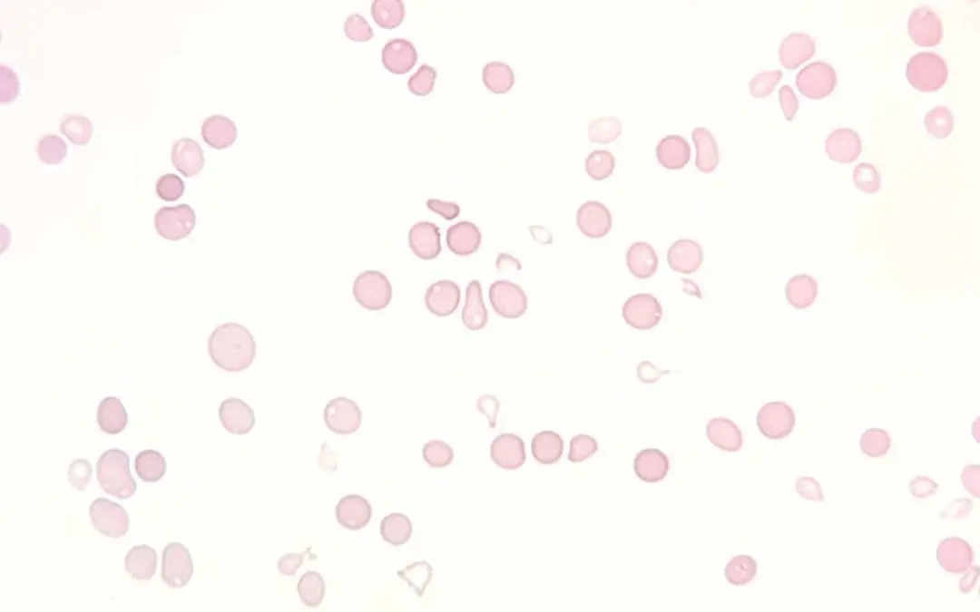 Aplastic Anemia (AA): A Bone Marrow Failure