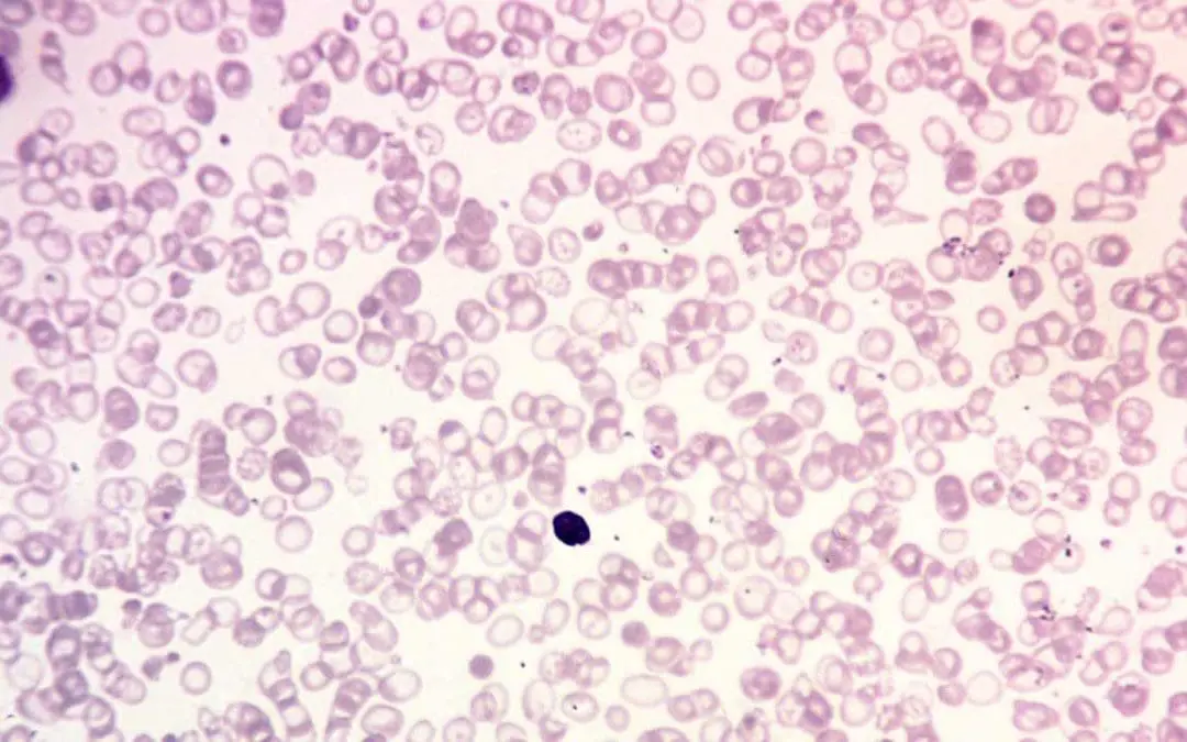 Beta-Thalassemia