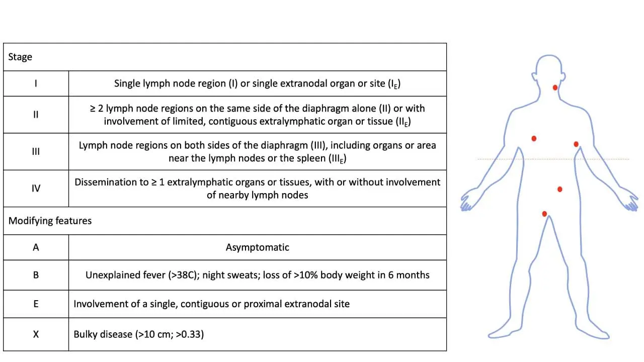 Image depicting the Ann Arbor staging system for Hodgkin lymphoma, highlighting the different stages and their corresponding involvement of lymph nodes and extranodal organs