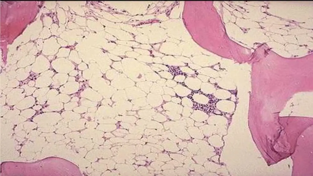 Hypocellular bone marrow seen in aplastic anemia.