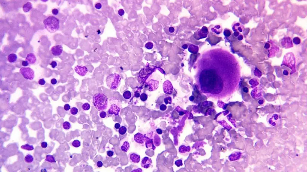 Visualizing the Cellular Landscape of Bone Marrow: MGG Stain Reveals Diverse Cellular Morphology (x400 Magnification)