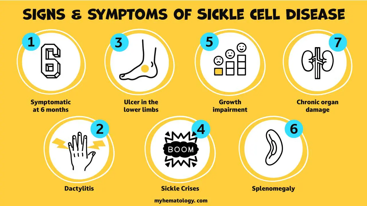 Signs and symptoms of sickle cell disease