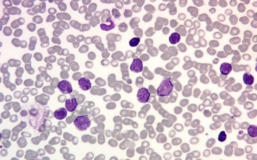 T-Cell Acute Lymphoblastic Leukemia or T-Cell ALL