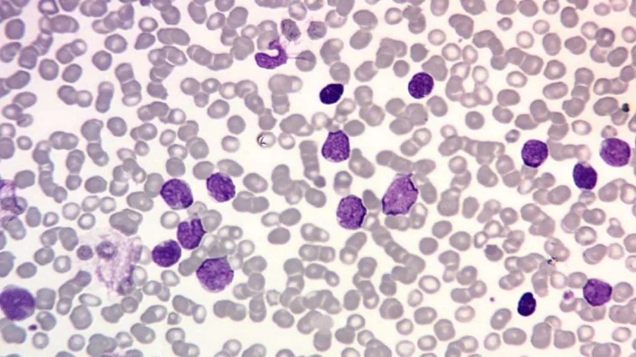 High-magnification peripheral blood smear revealing numerous lymphoblasts, indicative of acute lymphoblastic leukemia (ALL) including T-ALL.