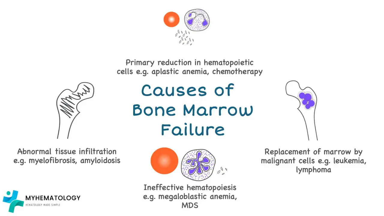 An illustration of the causes of bone marrow failure including primary reduction in hematopoietic cells, replacement of marrow by malignant cells, ineffective hematopoiesis and abnormal tissue infiltration