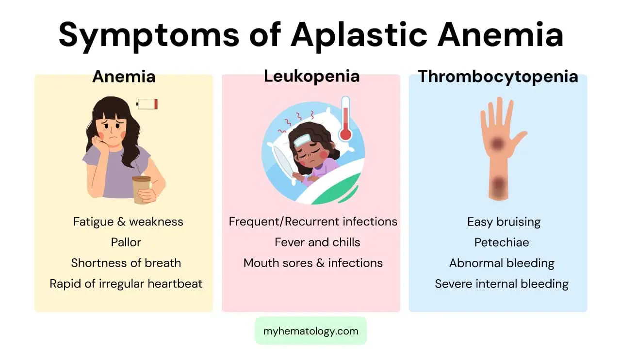 Symptoms of aplastic anemia include symptoms of anemia, leukopenia and thrombocytopenia