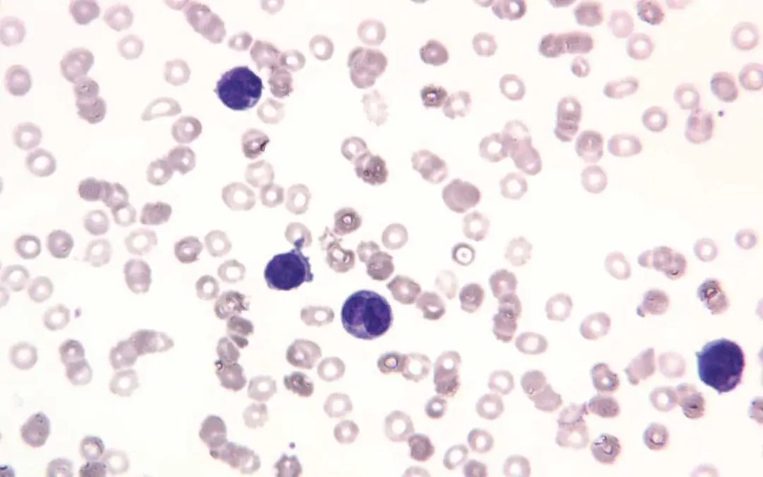 Leukemia: An Overview