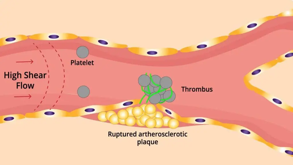 The pathophysiology of arterial thrombosis including artherosclerosis formation, plaque rupture, clot formation and thickening of vessel wall in arterial thrombosis
