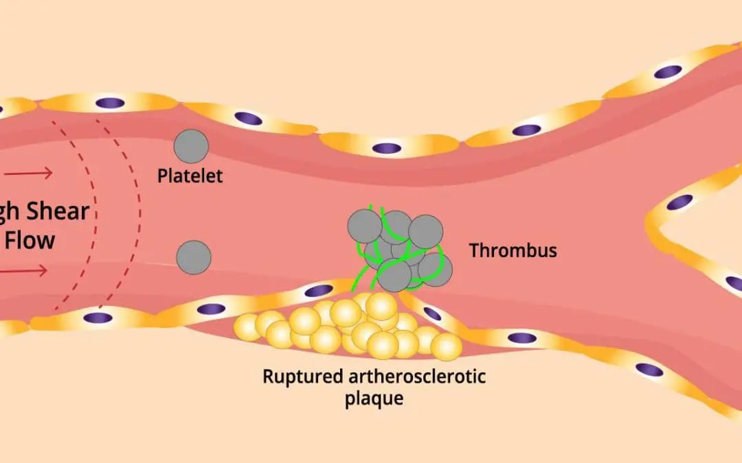 Arterial Thrombosis