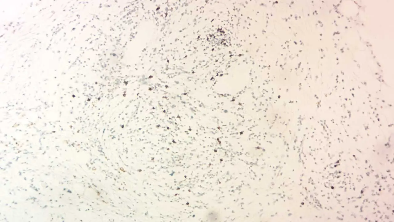 Microscopic view of a bone marrow biopsy showcasing a brown-stained CD20-positive B lymphocyte. This marker can reveal B-cell malignancies like lymphoma, aiding in accurate diagnosis. 