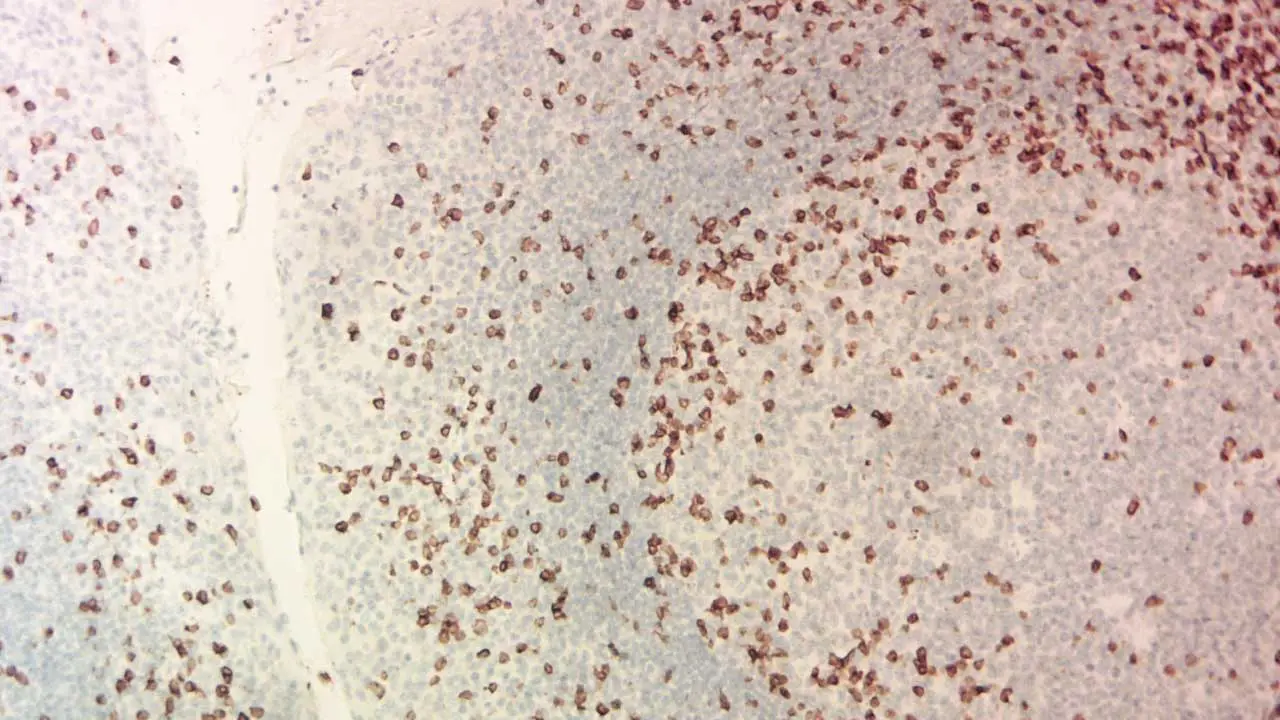 Microscopic image of a bone marrow trephine biopsy showcasing a CD3-positive T lymphocyte (brown stain) amidst other blood cells using IHC staining method. 