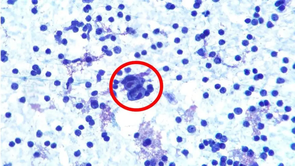 Lymph node biopsy showing the presence of Reed-Sternberg cell.
