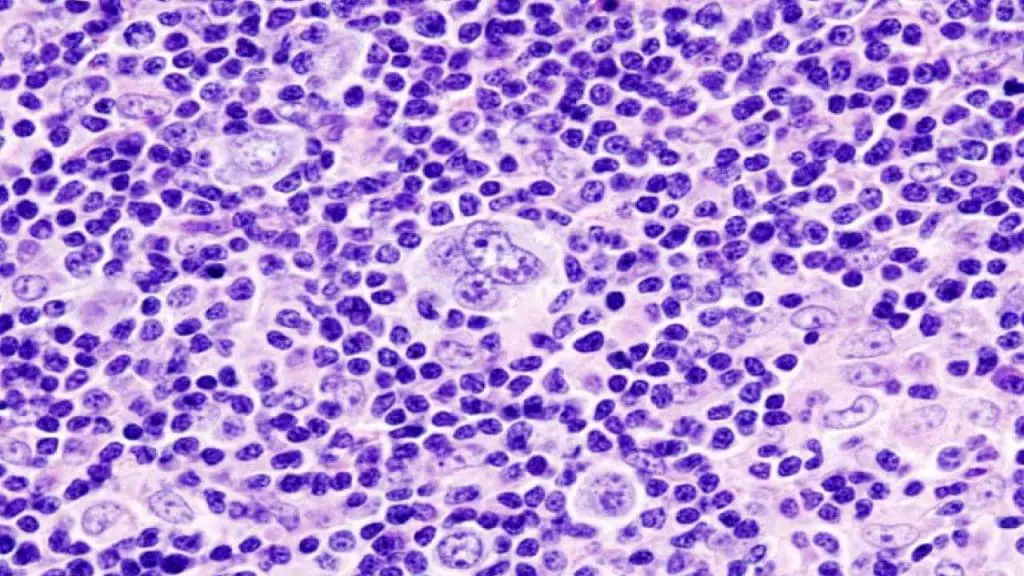 Histopathologic image of mixed cellularity Hodgkin lymphoma or Hodgkin's disease. Lymph node biopsy. H & E stain.