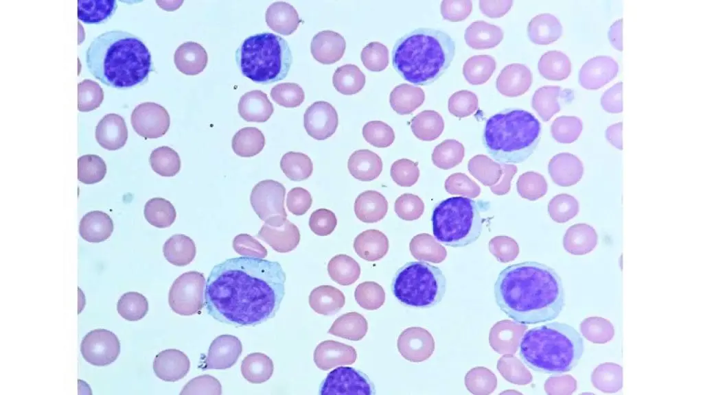Image depicting a peripheral blood smear showcasing the hallmark findings of CLL including lymphocytosis or high lymphocytes.