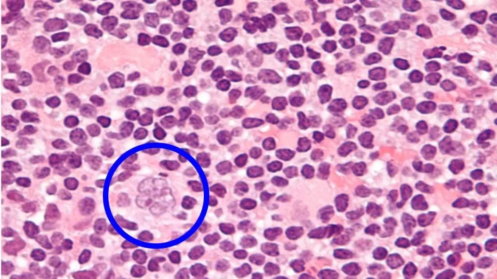Very high magnification micrograph of nodular lymphoctye predominant Hodgkin lymphoma (Hodgkin's disease), abbreviated NLPHL, with a popcorn-shaped Reed-Sternberg cell. H&E stain.