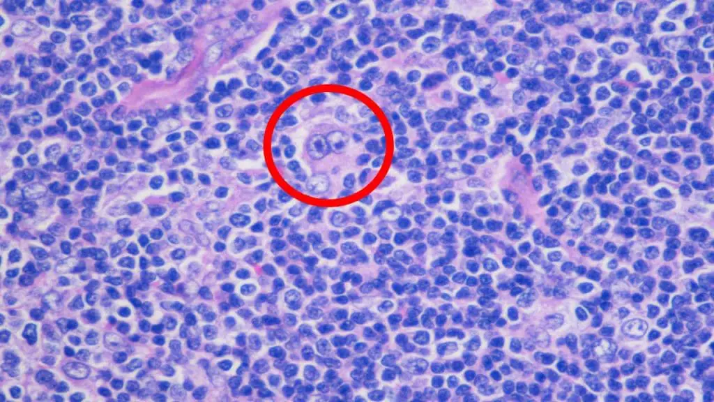 Classical Hodgkin Lymphoma or Hodgkin's disease with classic Reed-Sternberg cell (upper center of picture)