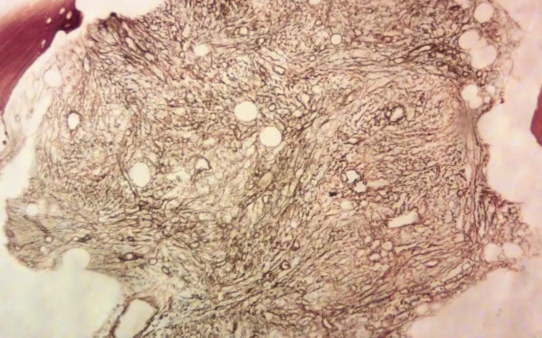Primary Myelofibrosis (PMF)