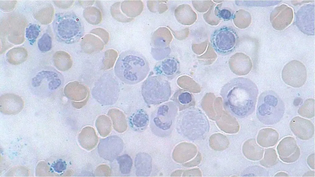 Ring sideroboblasts