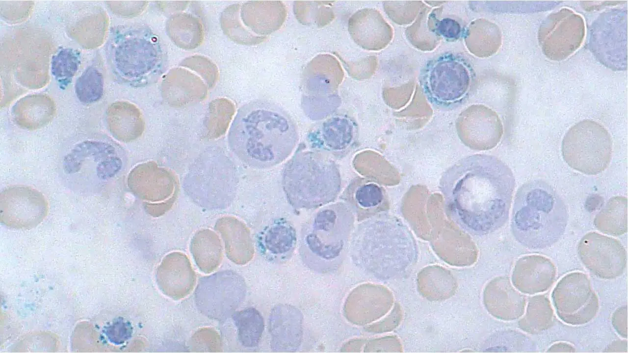 Sideroblastic Anemia