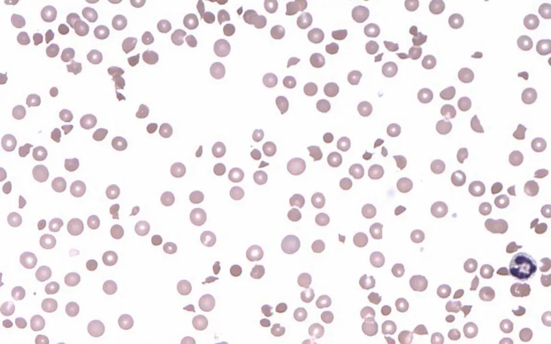 Thrombocytopenia