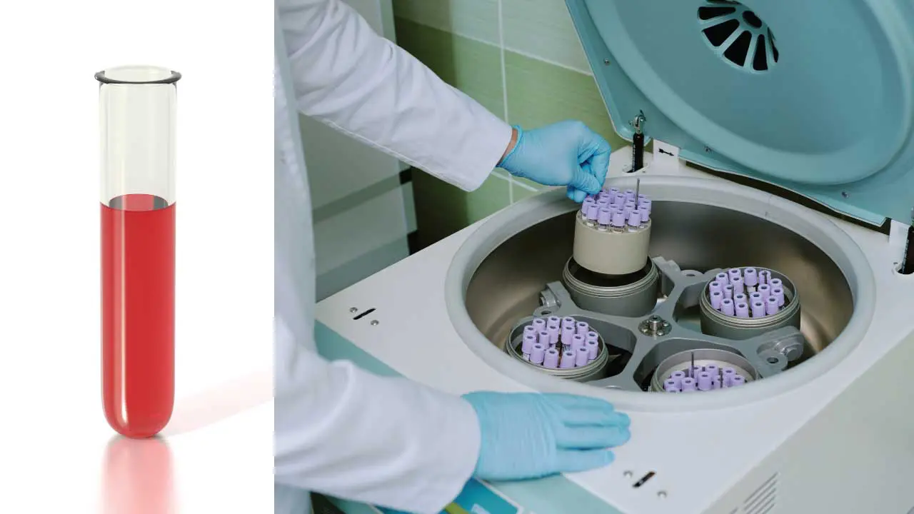 Hemolysate preparation will produce a clear and transparent hemolysate to be used for further hemoglobinopathies and thalassemia investigation. 