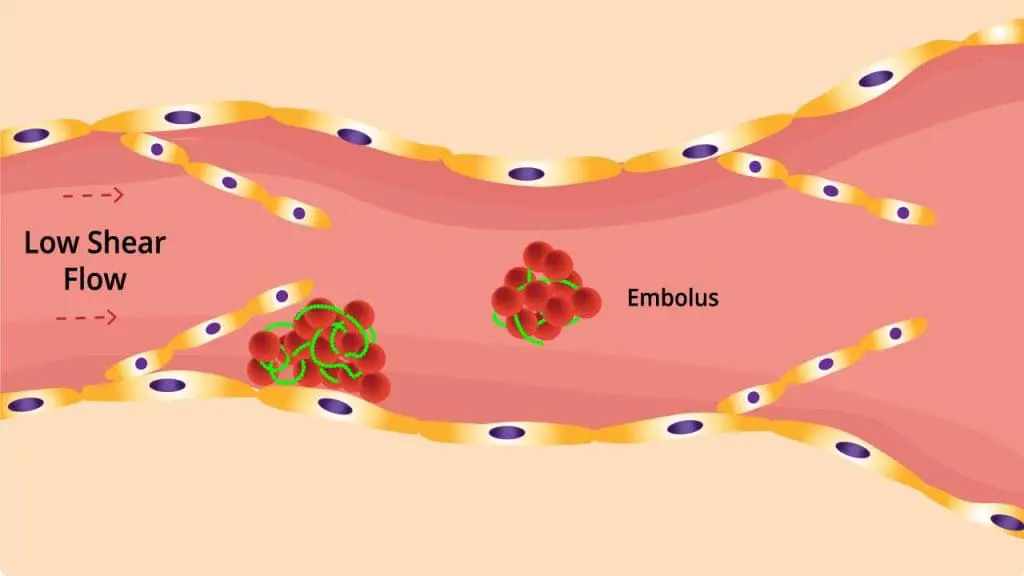 Mechanism of deep vein thrombosis (DVT): Blood flow slows and pools causing platelets to clump causing fibrin mesh to trap cells and forming a clot. Breakaway clot can travel to lungs, leading to life-threatening pulmonary embolism (PE).