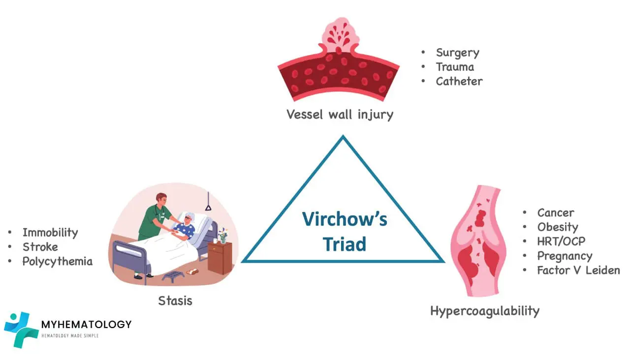 Virchow’s Triad is the foundational framework for understanding venous thrombogenesis or venous thromboembolism also known as VTE on a pathophysiological level, consisting of three intersecting factors: venous stasis, endothelial injury, and hypercoagulability. Venous stasis occurs when blood flow slows or pools often due to prolonged immobility, obesity, pregnancy, or heart failure, allowing activated clotting factors to accumulate in the low-pressure valve pockets of deep veins. Endothelial injury acts as the primary trigger, where damage to the vessel wall from surgery, trauma, or intravenous catheters exposes the pro-thrombotic subendothelial matrix to platelets. Finally, hypercoagulability represents a biochemical shift toward a pro-thrombotic state, driven by inherited conditions like Factor V Leiden or Protein C/S deficiency, or acquired triggers such as malignancy, oral contraceptives, and smoking. When these three elements coincide, they overwhelm the body’s natural anticoagulant defenses, leading to the formation of a fibrin-rich thrombus that characterizes venous thromboembolism.