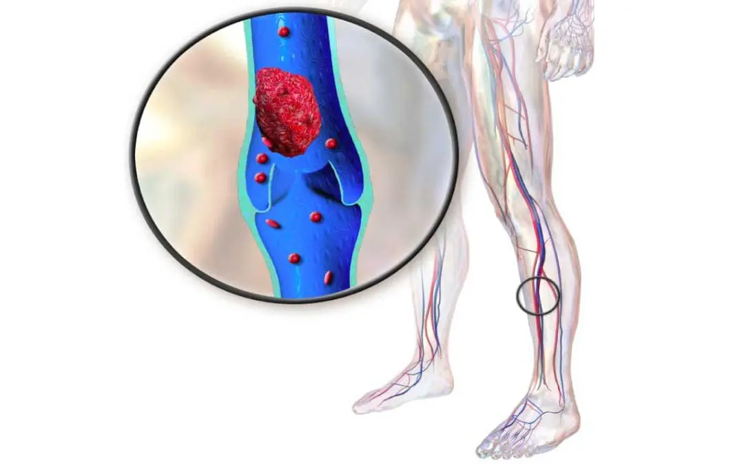 Deep Vein Thrombosis (DVT)