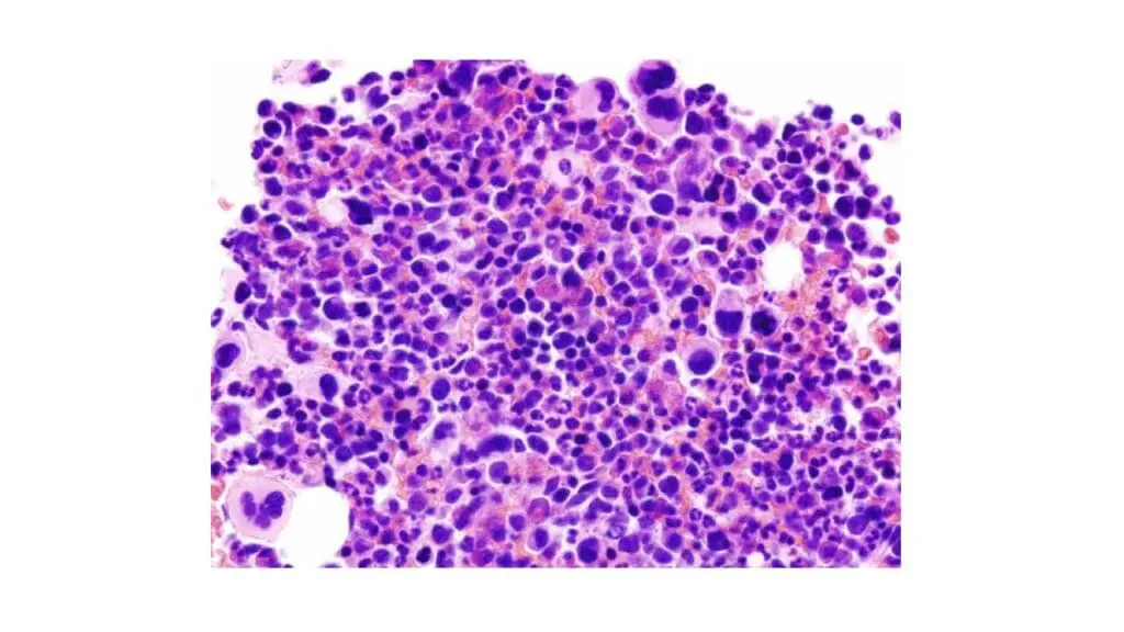 Bone marrow aspirate in essential thrombocythemia