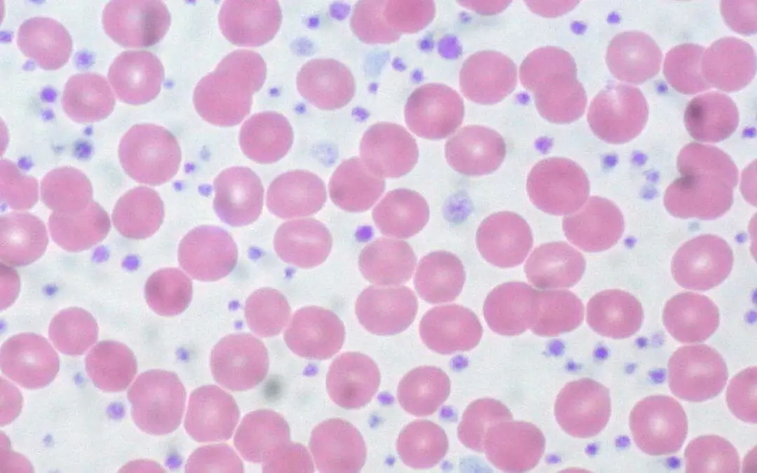 Essential Thrombocythemia (ET)