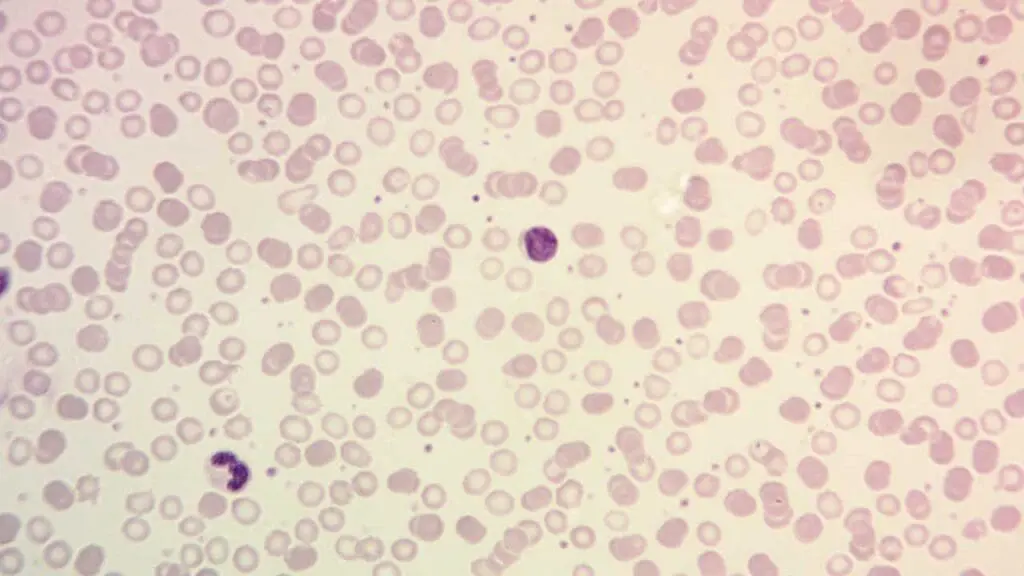 Close-up image of a peripheral blood smear showing thrombocytosis. Numerous red blood cells are visible, along with an abnormally high number of platelets, appearing as small purple dots of various sizes and shapes, distributed throughout the smear. This increased platelet count is characteristic of thrombocytosis, a medical condition where the body produces too many platelets.