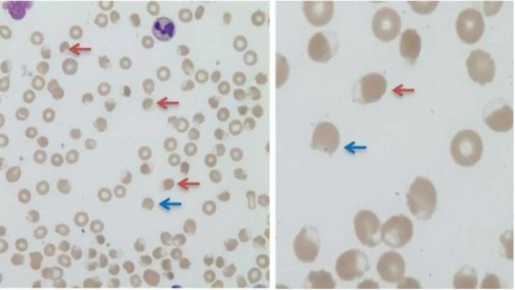 Blister cells are indicated by the red arrows while the blue arrows indicate a bite cells.