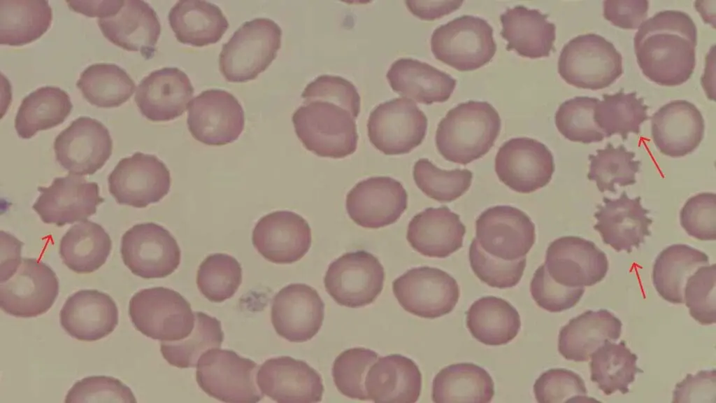 Echinocytes (Burr or crenated red cells) have numerous small evenly spaced spikes in the red blood cell morphology.